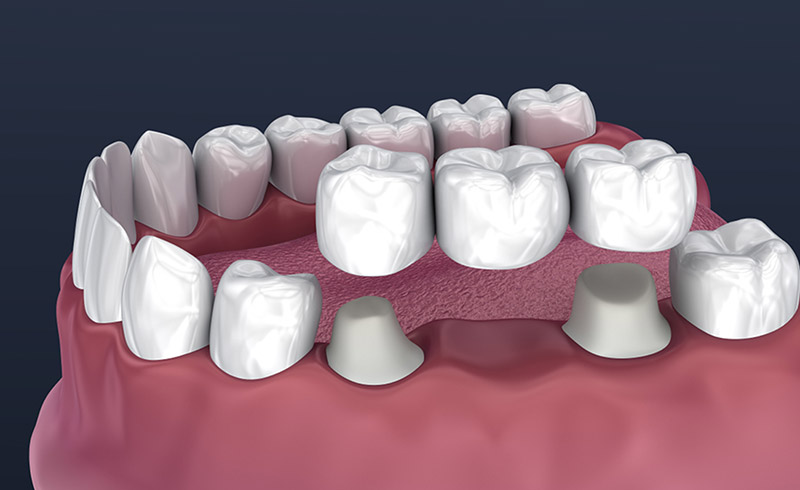 Dental Bridges in Vancouver