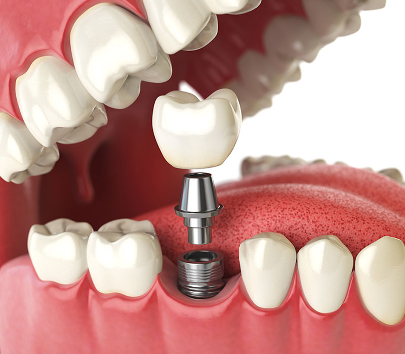 Dental Implants in Vancouver