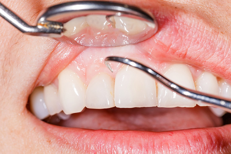 Gum Disease Treatment in Vancouver