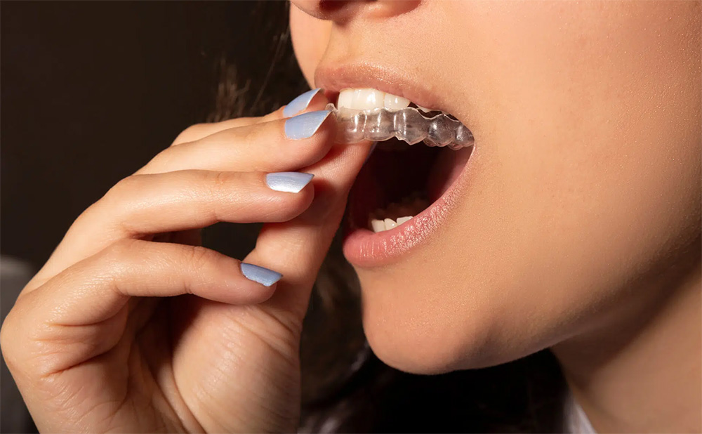 invisalign in Vancouver