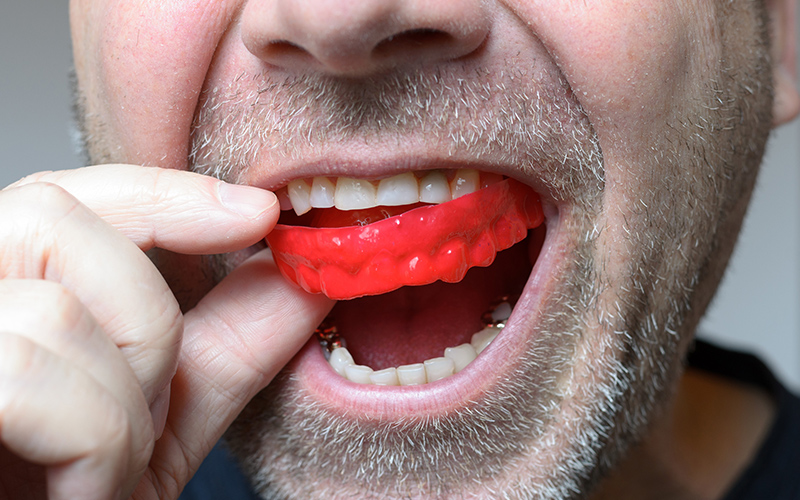 Mouthguards in Vancouver