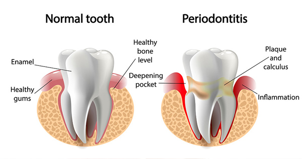 Periodontist in Vancouver