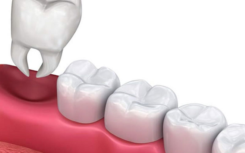 Wisdom Teeth Removal in Vancouver